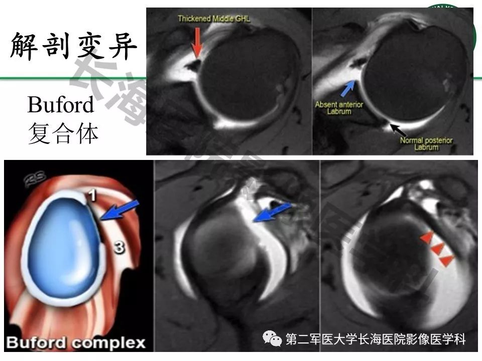影像PPT - 【PPT】肩关节不稳影像表现-7