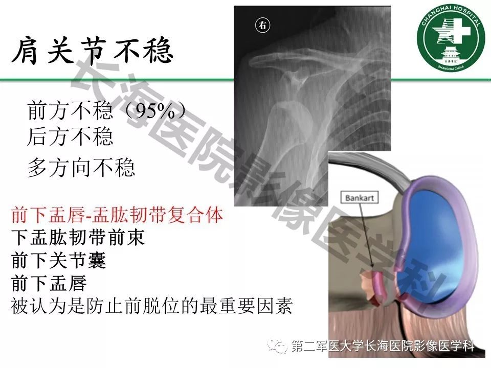 影像PPT - 【PPT】肩关节不稳影像表现-8