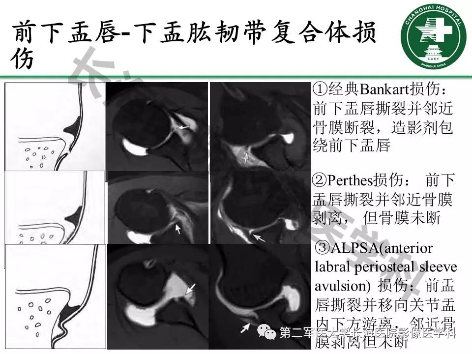影像PPT - 【PPT】肩关节不稳影像表现-10