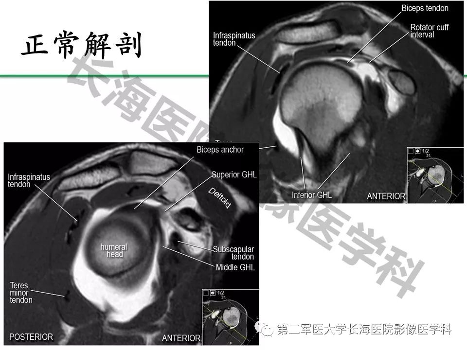 影像PPT - 【PPT】肩关节不稳影像表现-4
