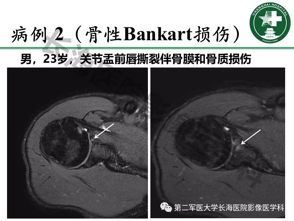 影像PPT - 【PPT】肩关节不稳影像表现-15