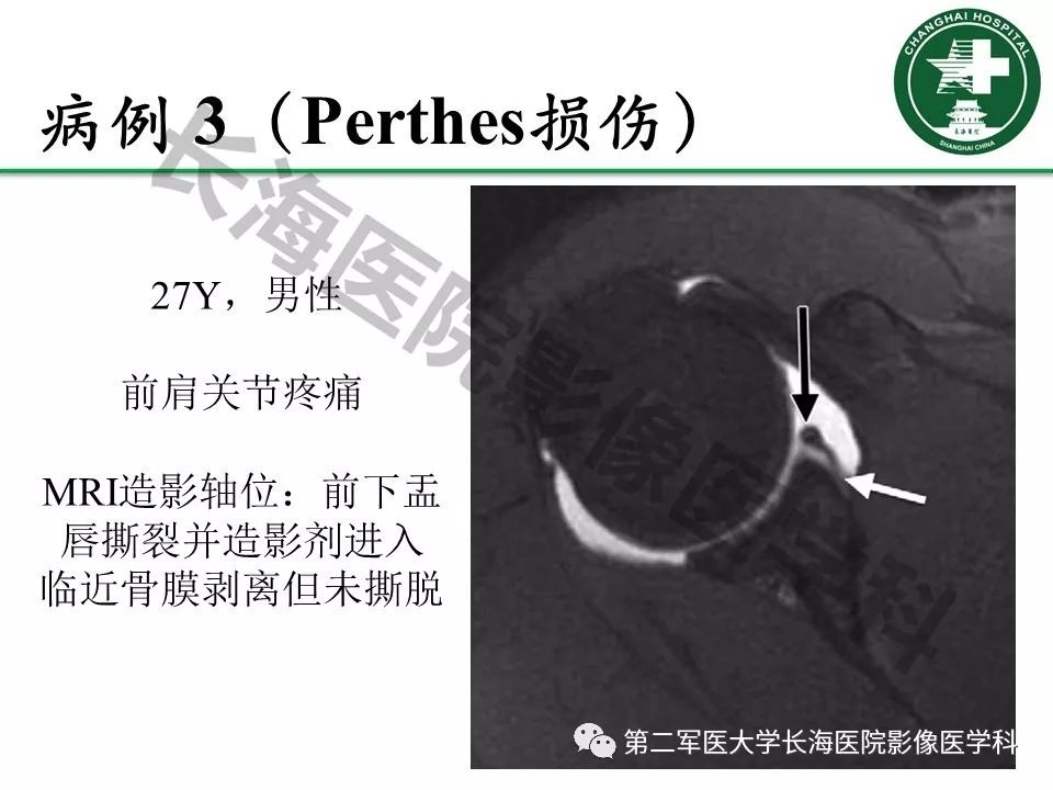 影像PPT - 【PPT】肩关节不稳影像表现-16