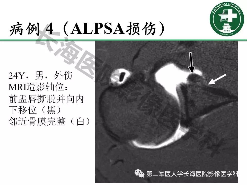 影像PPT - 【PPT】肩关节不稳影像表现-17