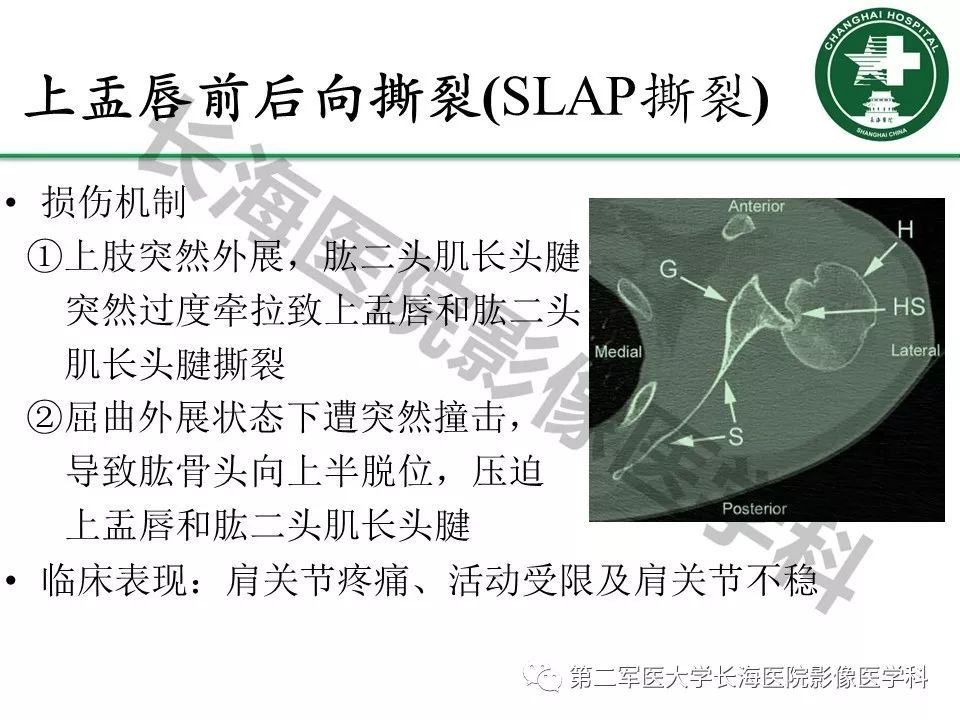 影像PPT - 【PPT】肩关节不稳影像表现-19