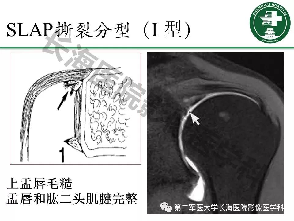影像PPT - 【PPT】肩关节不稳影像表现-20