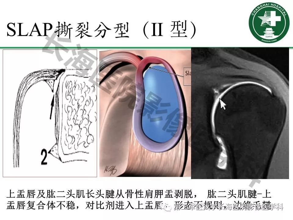 影像PPT - 【PPT】肩关节不稳影像表现-21