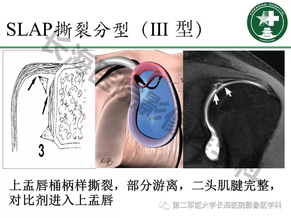 影像PPT - 【PPT】肩关节不稳影像表现-22