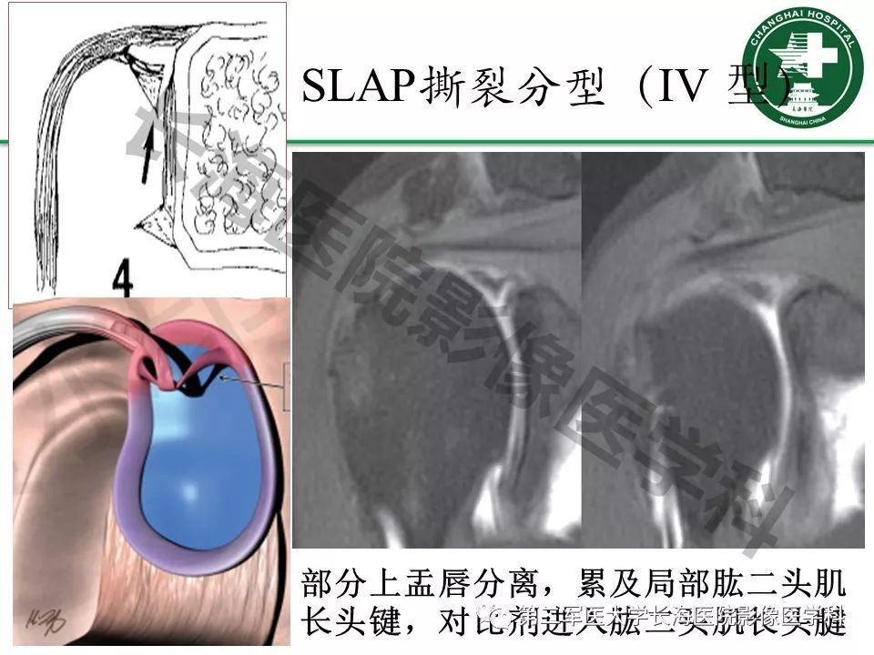 影像PPT - 【PPT】肩关节不稳影像表现-23