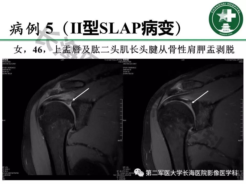 影像PPT - 【PPT】肩关节不稳影像表现-24