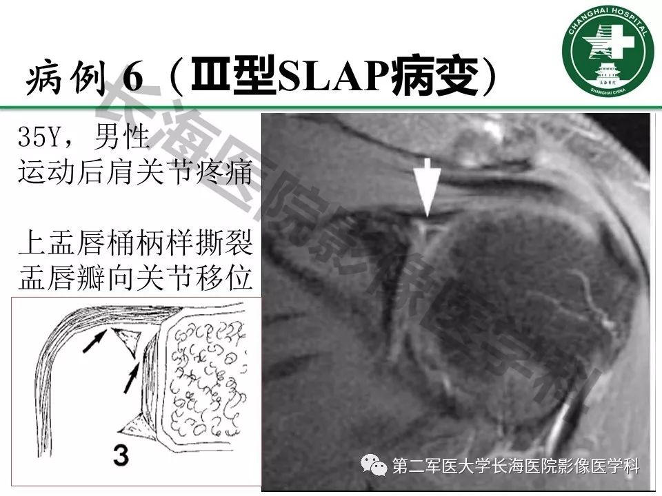 影像PPT - 【PPT】肩关节不稳影像表现-25