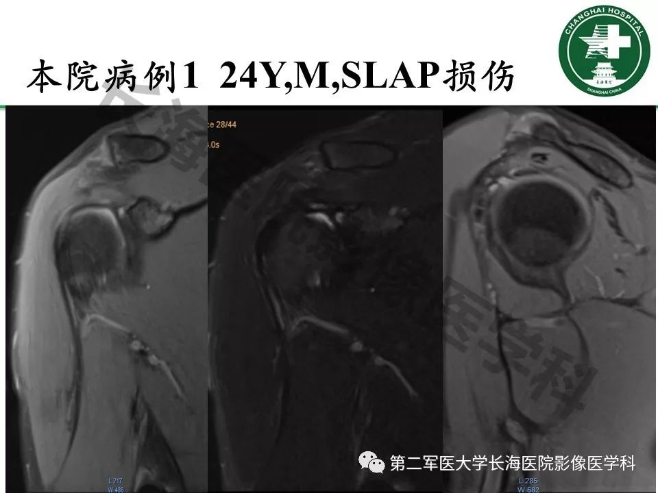 影像PPT - 【PPT】肩关节不稳影像表现-26