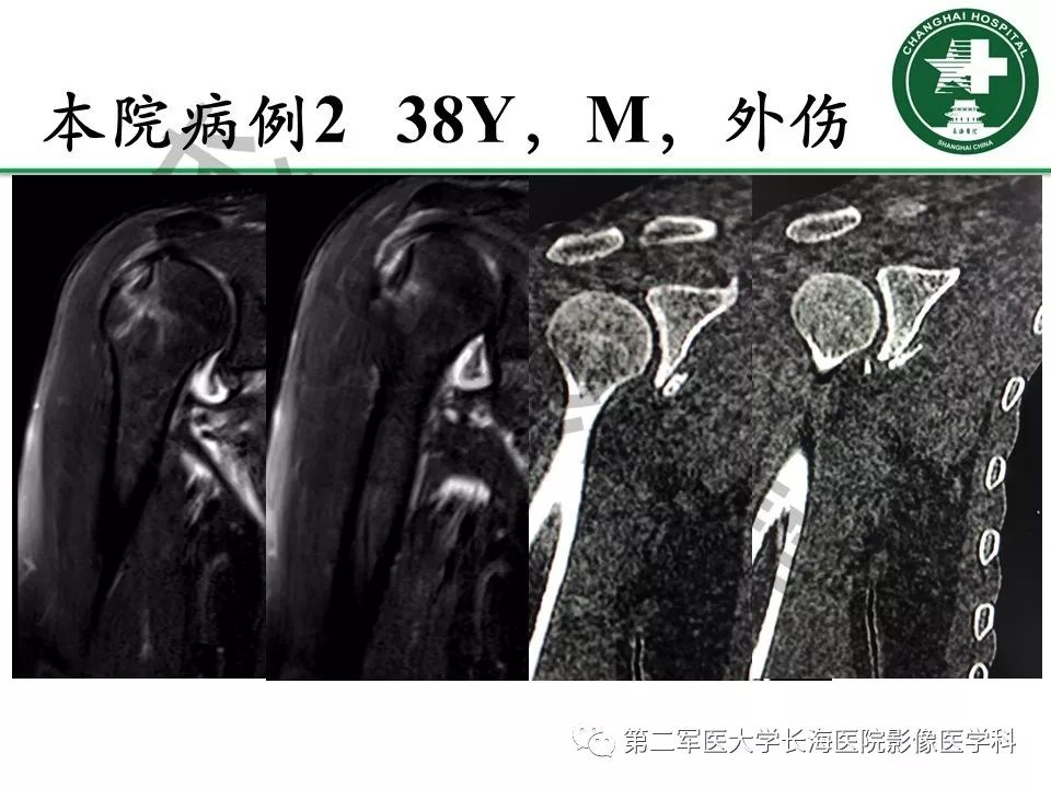 影像PPT - 【PPT】肩关节不稳影像表现-27