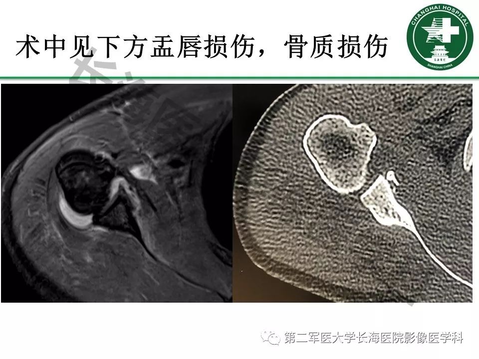 影像PPT - 【PPT】肩关节不稳影像表现-28