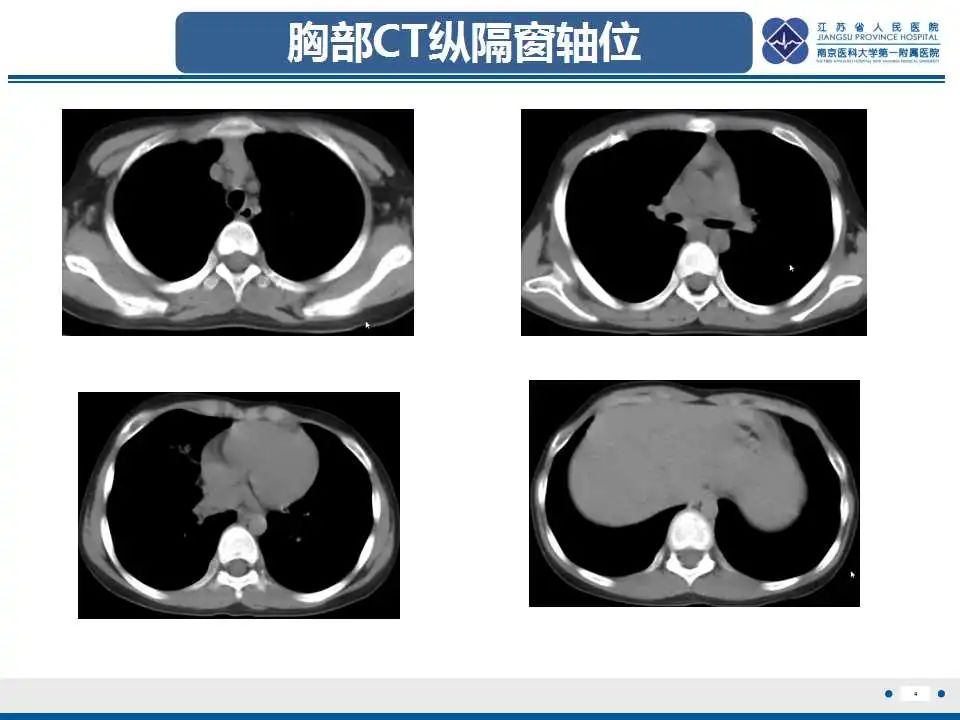 影像PPT - 【PPT】佝偻病-4