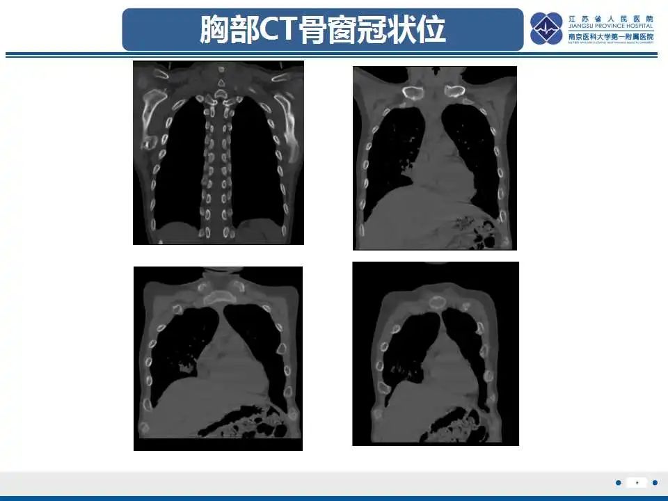 影像PPT - 【PPT】佝偻病-6