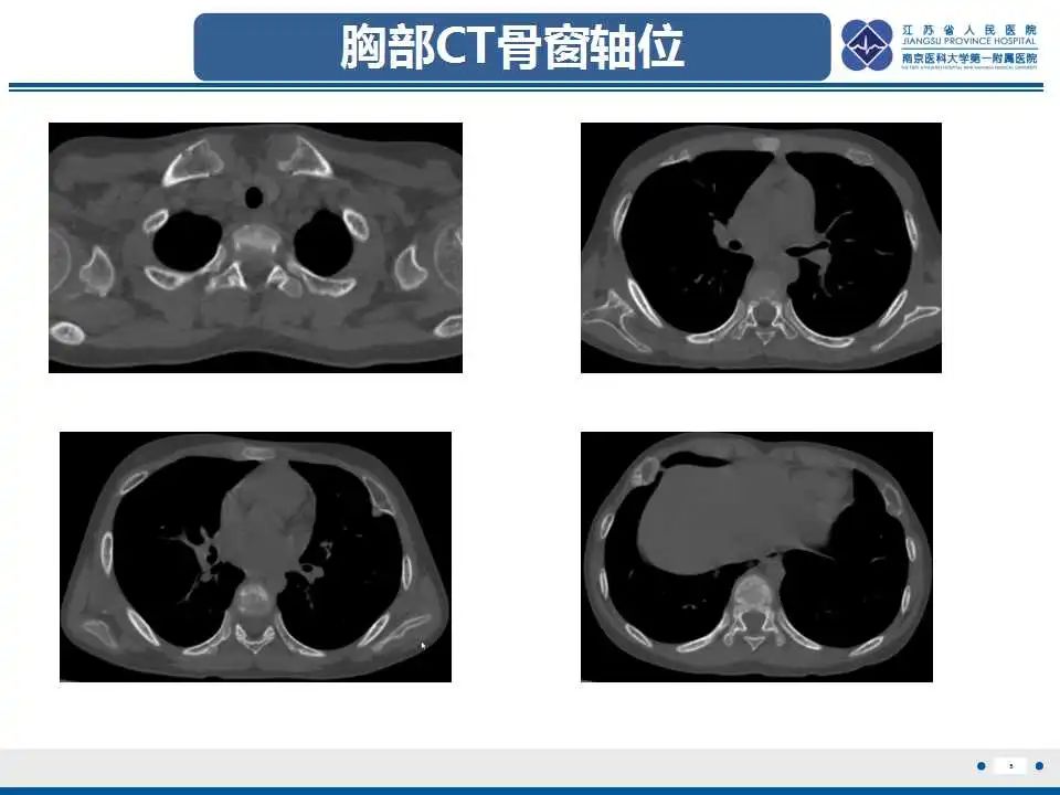 影像PPT - 【PPT】佝偻病-5