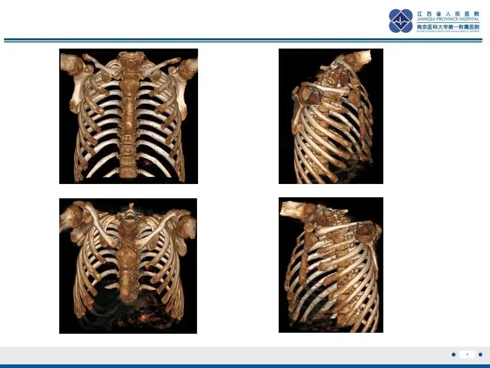 影像PPT - 【PPT】佝偻病-7