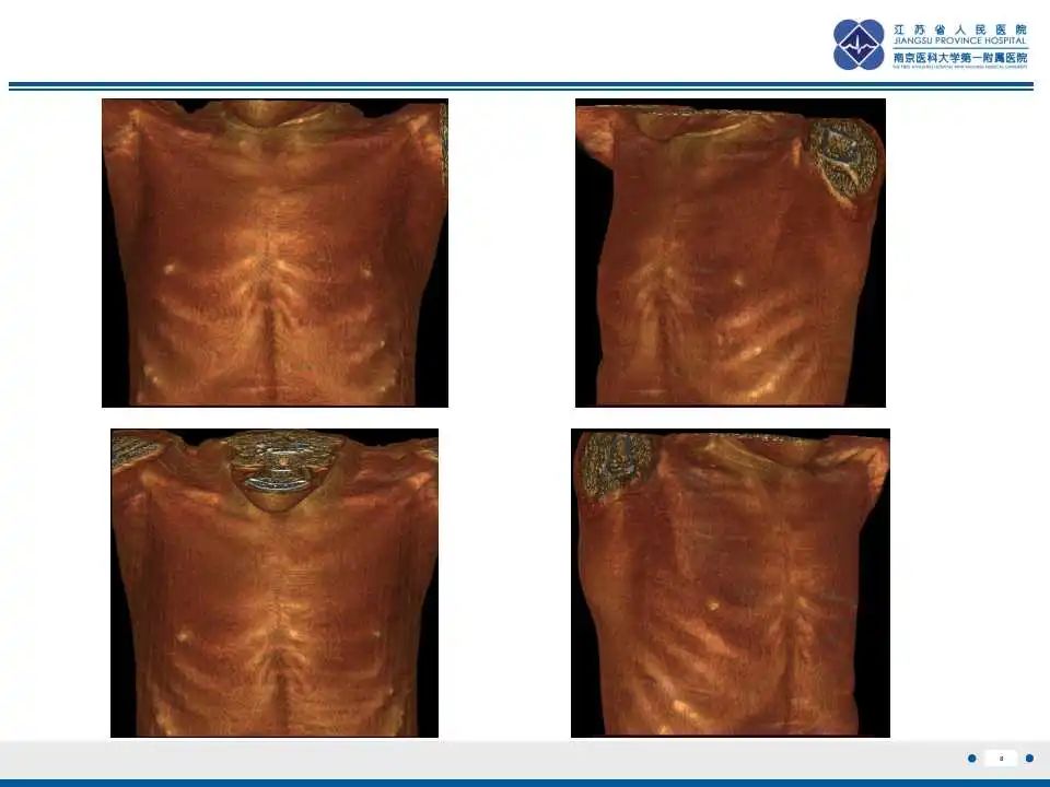 影像PPT - 【PPT】佝偻病-8
