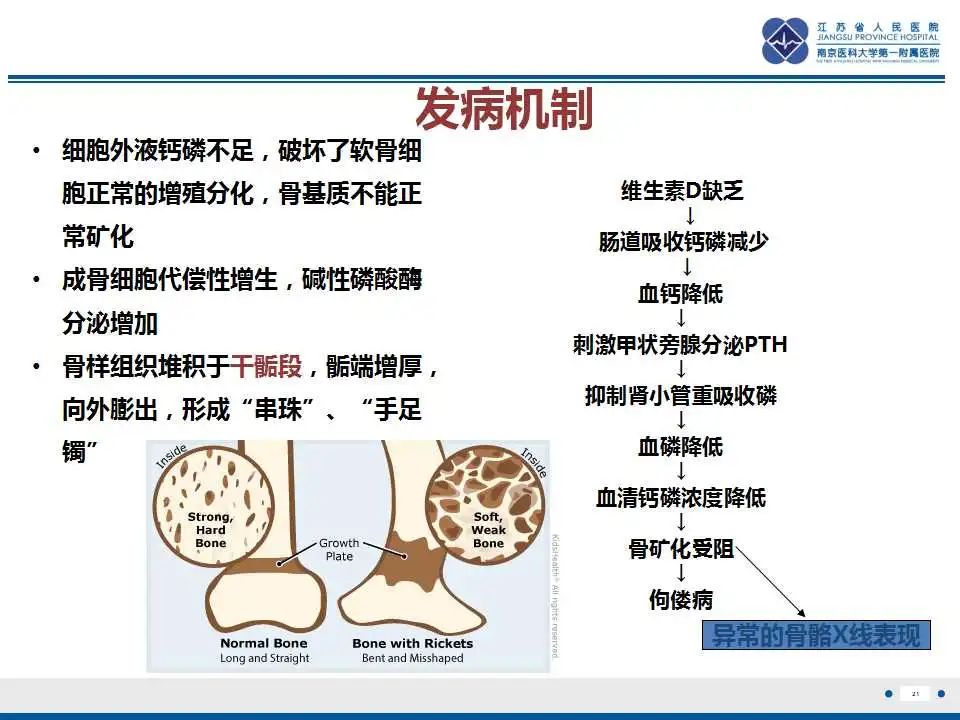 影像PPT - 【PPT】佝偻病-21