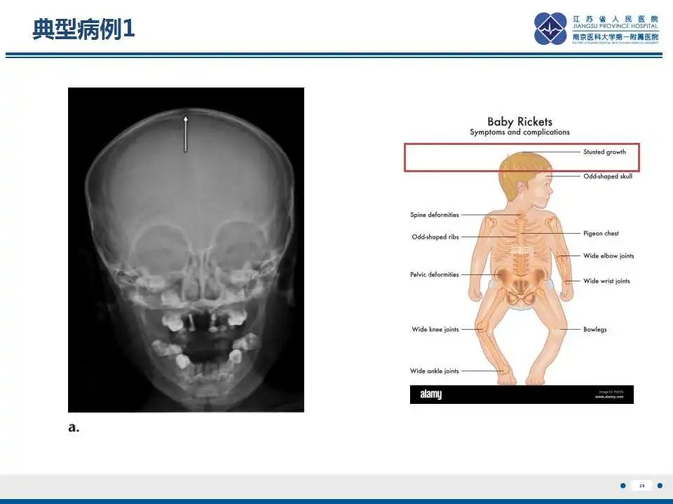 影像PPT - 【PPT】佝偻病-28