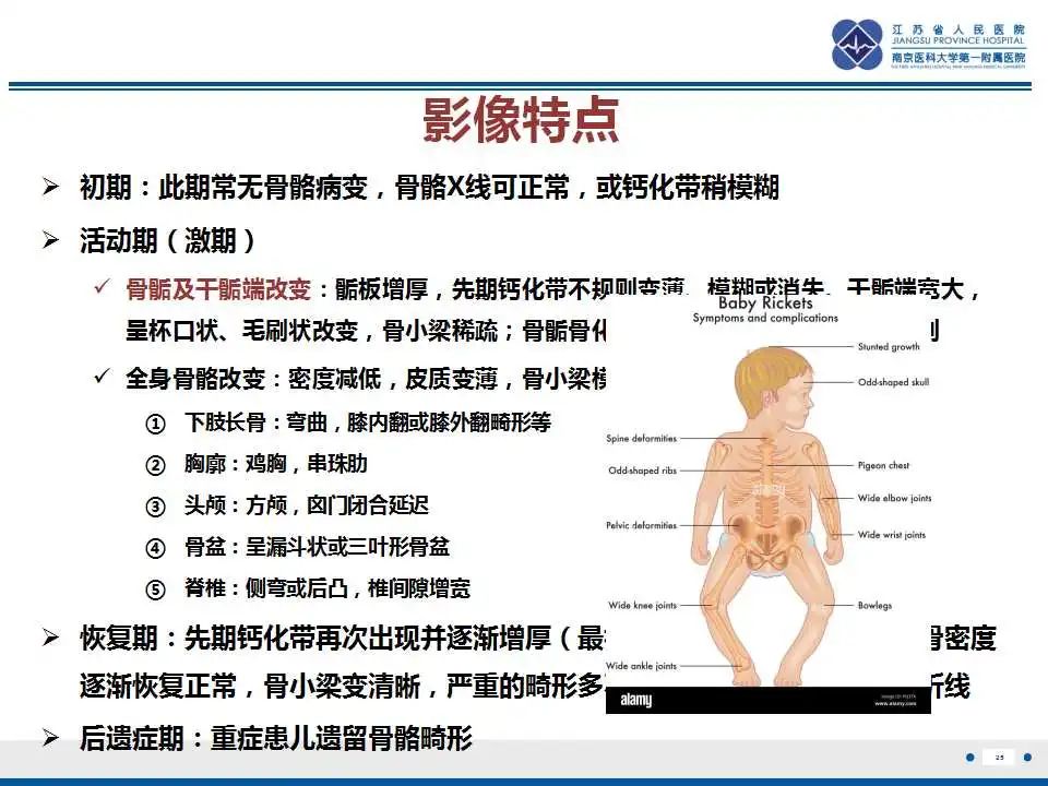 影像PPT - 【PPT】佝偻病-25