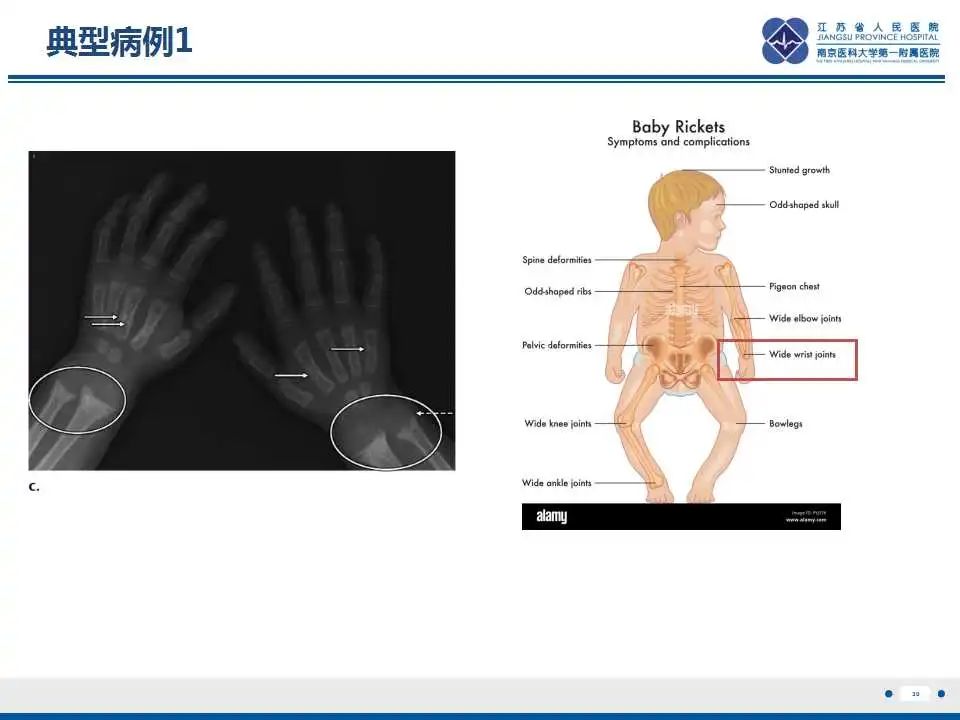 影像PPT - 【PPT】佝偻病-30