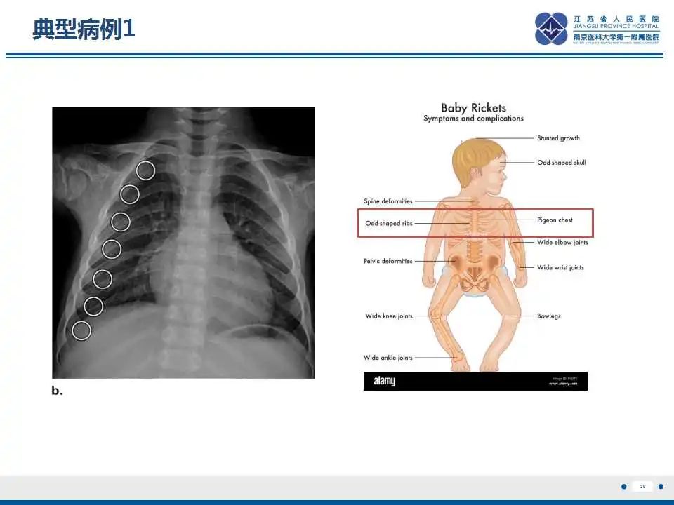 影像PPT - 【PPT】佝偻病-29
