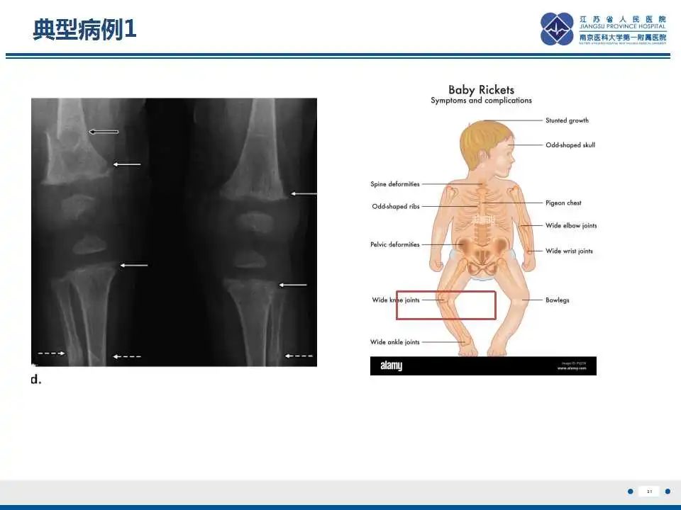 影像PPT - 【PPT】佝偻病-31
