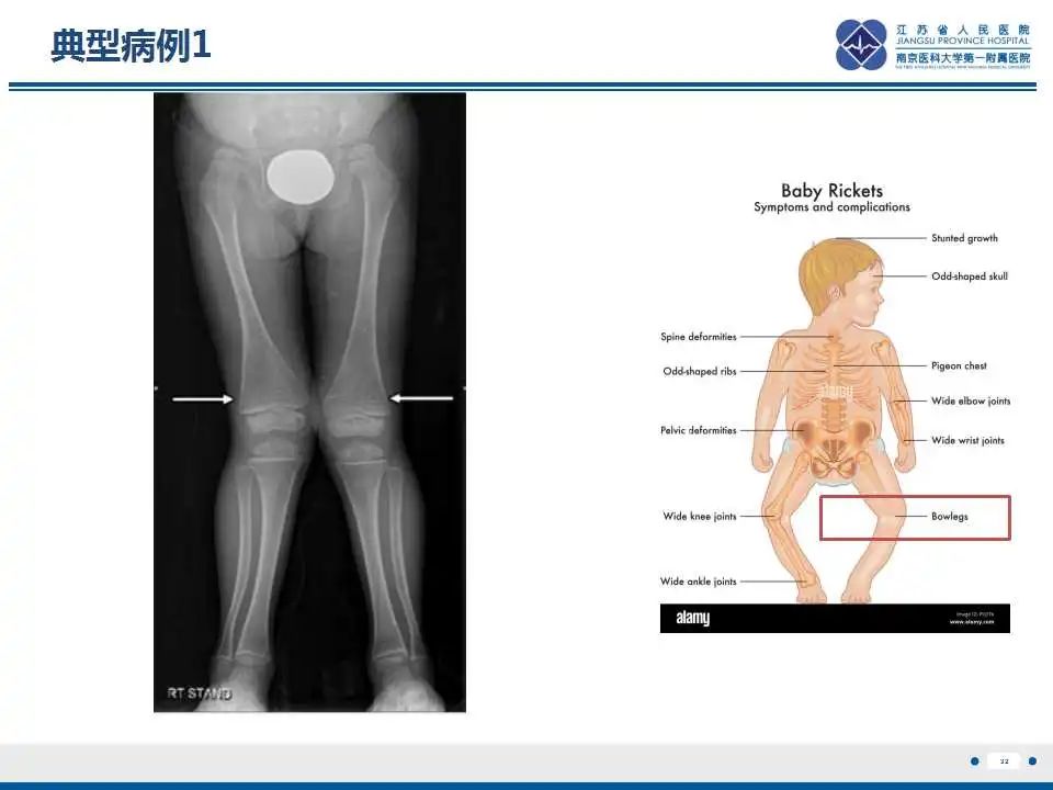 影像PPT - 【PPT】佝偻病-32