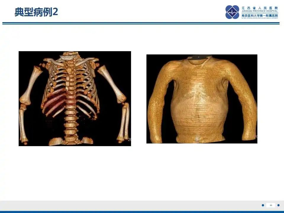 影像PPT - 【PPT】佝偻病-33