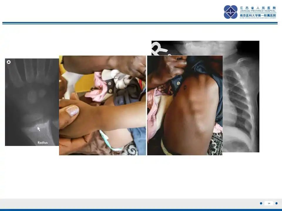 影像PPT - 【PPT】佝偻病-34