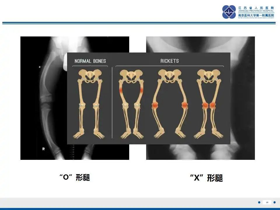 影像PPT - 【PPT】佝偻病-35