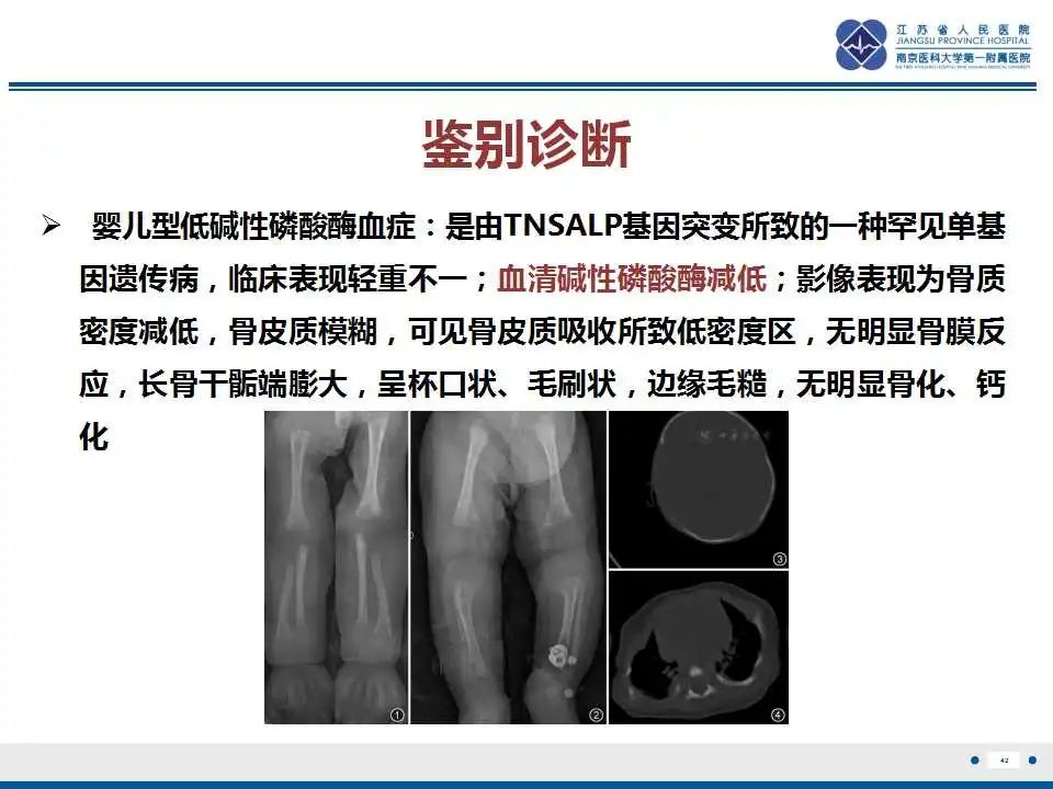影像PPT - 【PPT】佝偻病-42