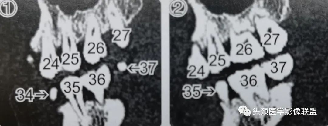 影像PPT - 牙齿影像解剖-5 影像PPT - 牙齿影像解剖-5