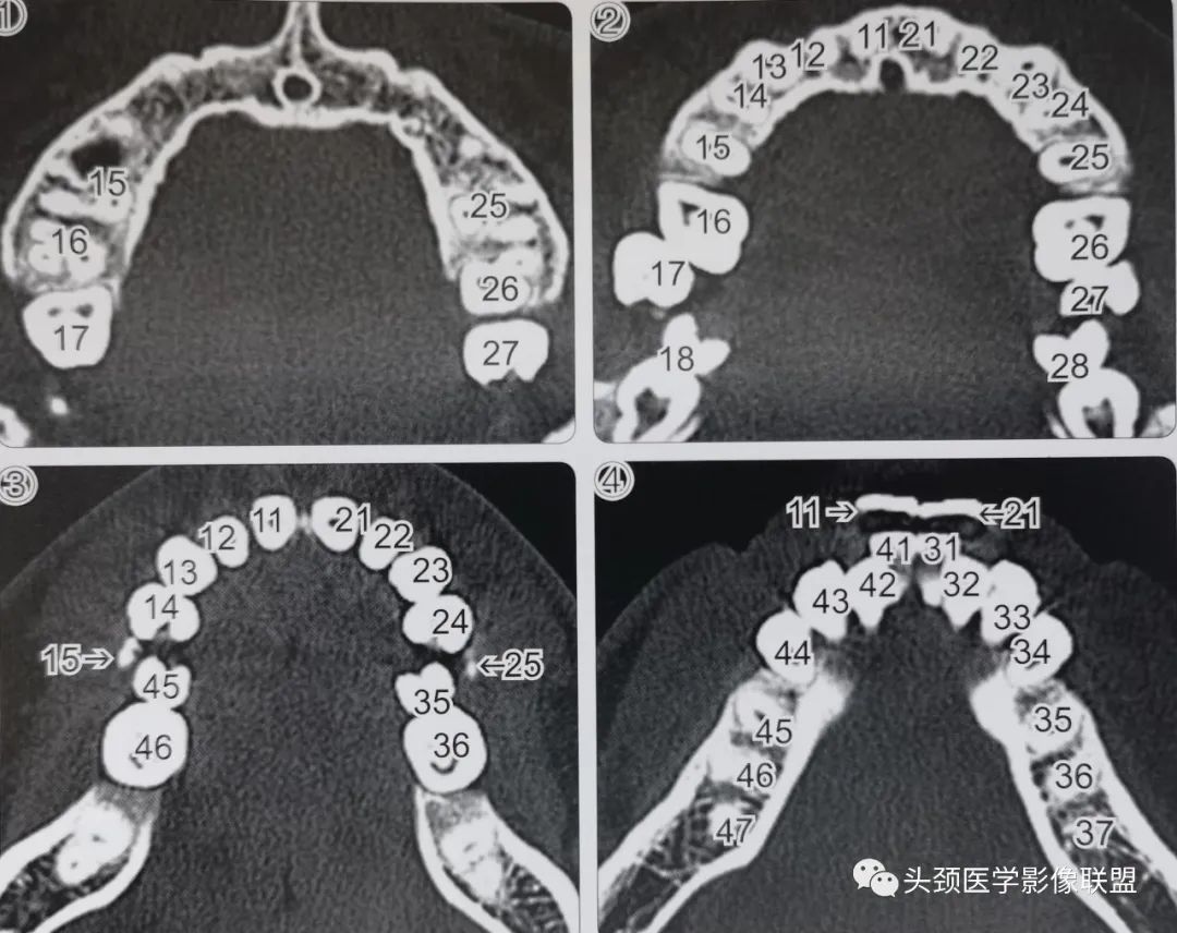 影像PPT - 牙齿影像解剖-4 影像PPT - 牙齿影像解剖-4