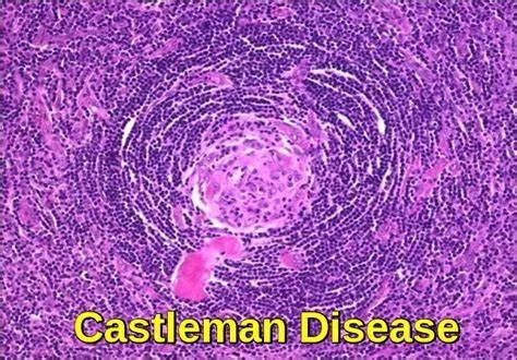 影像PPT - 【病例】盆腔内明显强化结节,鉴别诊断需要想到 Castleman病-9 影像PPT - 【病例】盆腔内明显强化结节,鉴别诊断需要想到 Castleman病-9