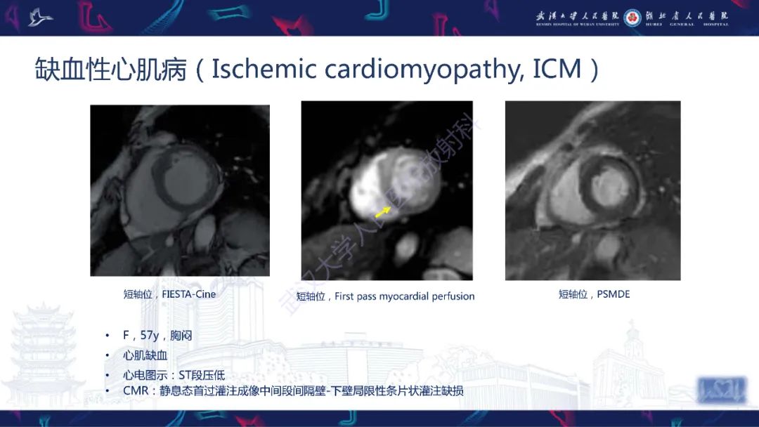 影像PPT - 【PPT】心脏磁共振临床应用-32