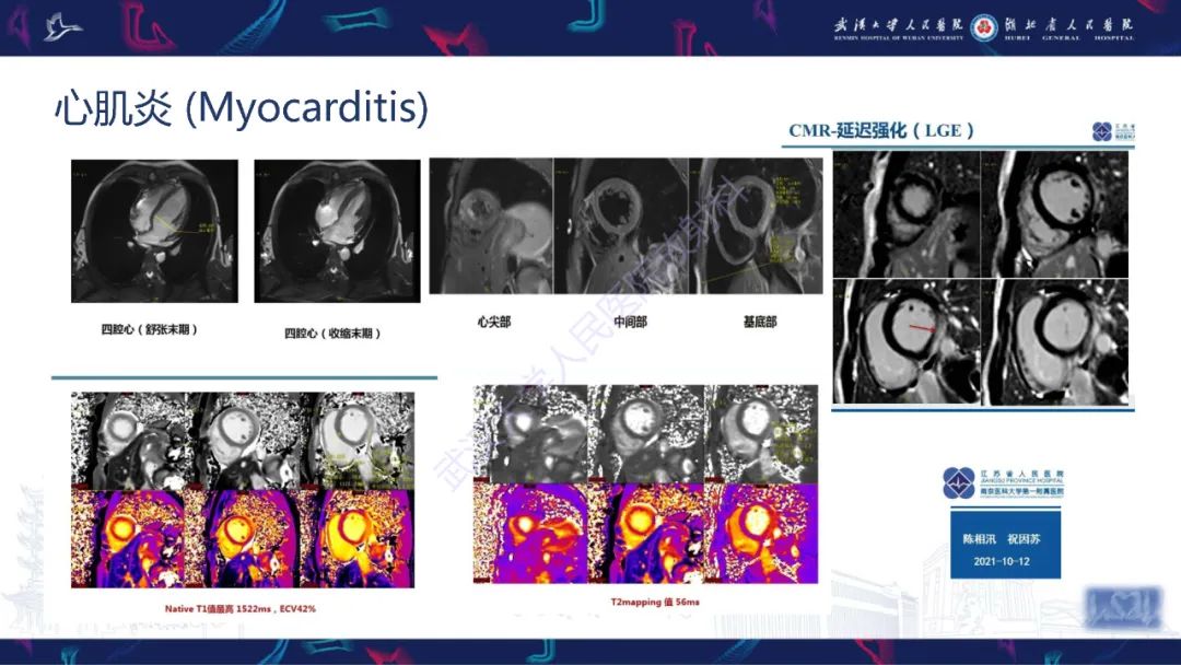 影像PPT - 【PPT】心脏磁共振临床应用-36