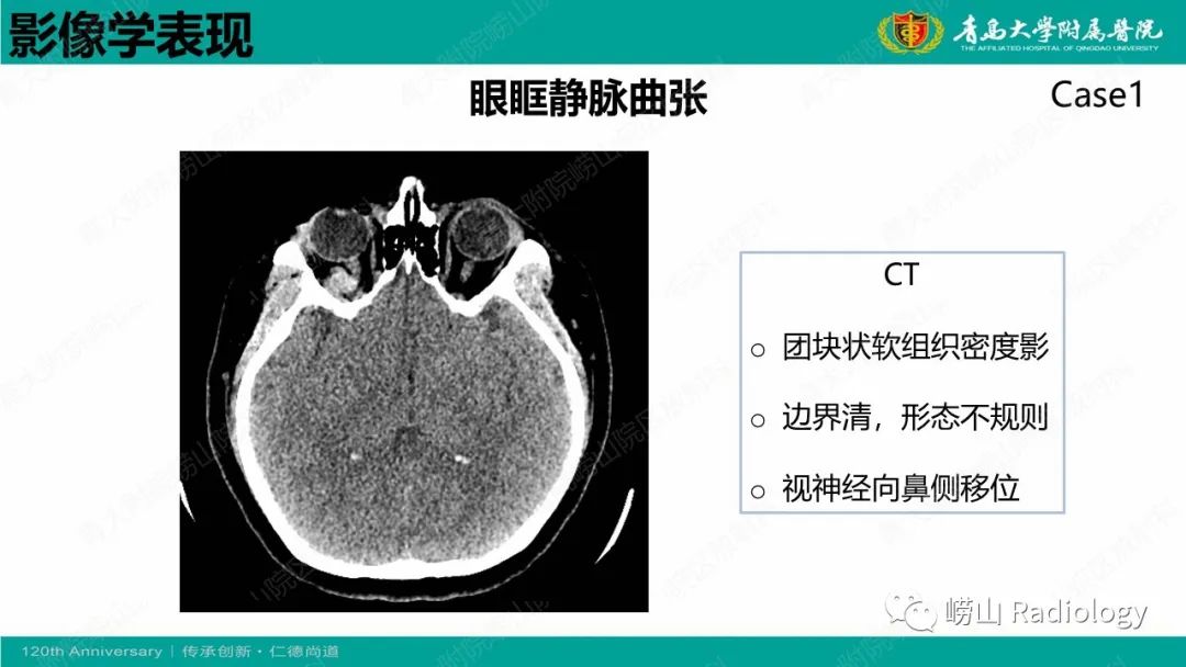 影像PPT - 【PPT】眼眶静脉曲张-8