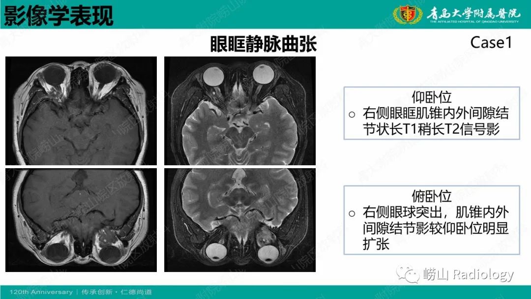 影像PPT - 【PPT】眼眶静脉曲张-9