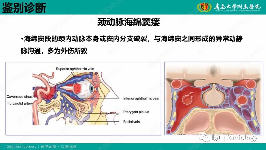影像PPT - 【PPT】眼眶静脉曲张-22