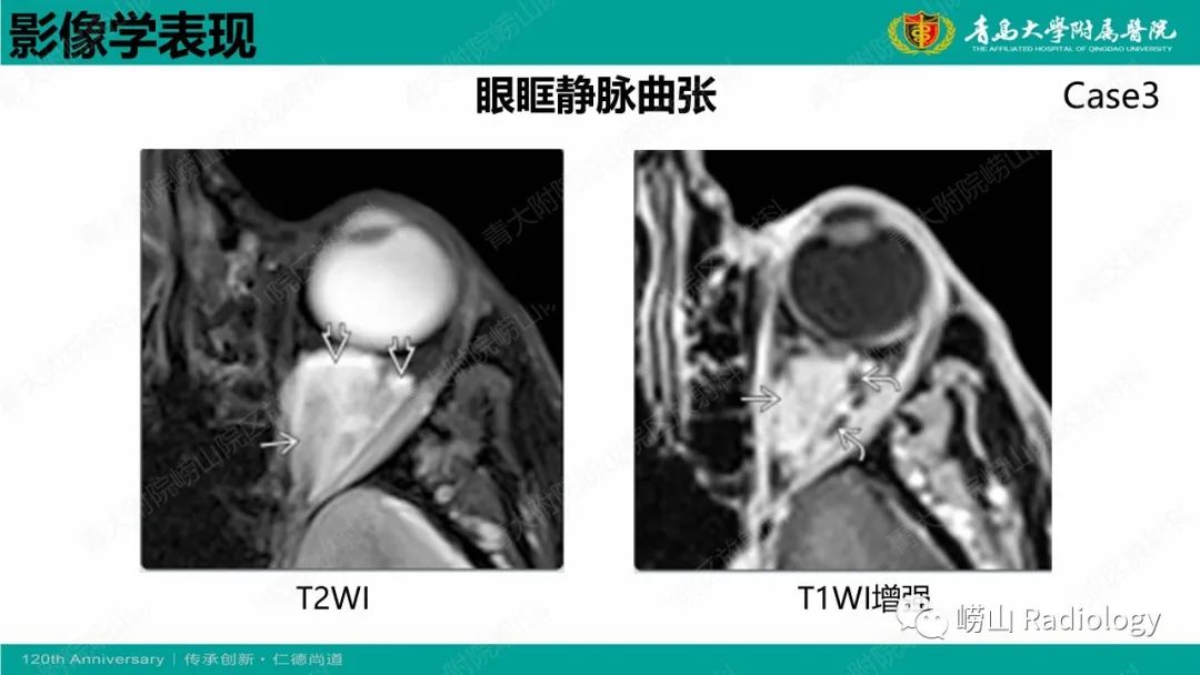 影像PPT - 【PPT】眼眶静脉曲张-13