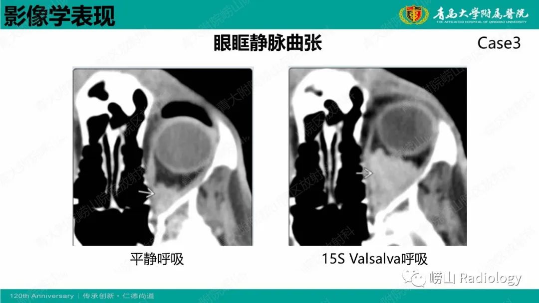 影像PPT - 【PPT】眼眶静脉曲张-14