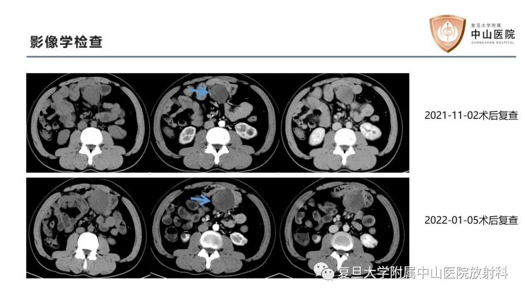 影像PPT - 【病例】肠系膜孤立性肿块3例CT影像鉴别分析-9