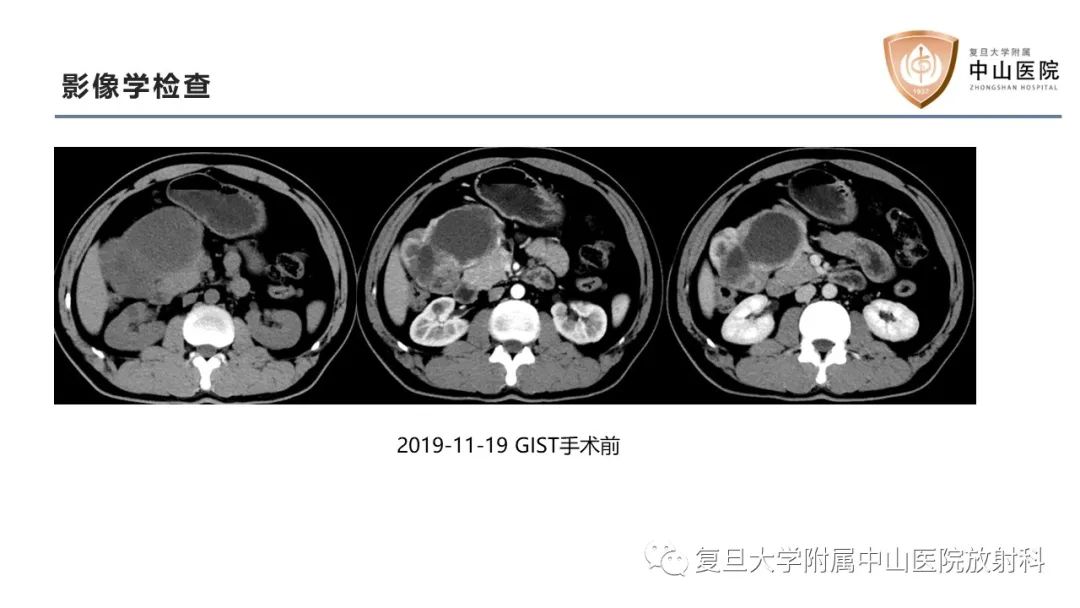 影像PPT - 【病例】肠系膜孤立性肿块3例CT影像鉴别分析-7