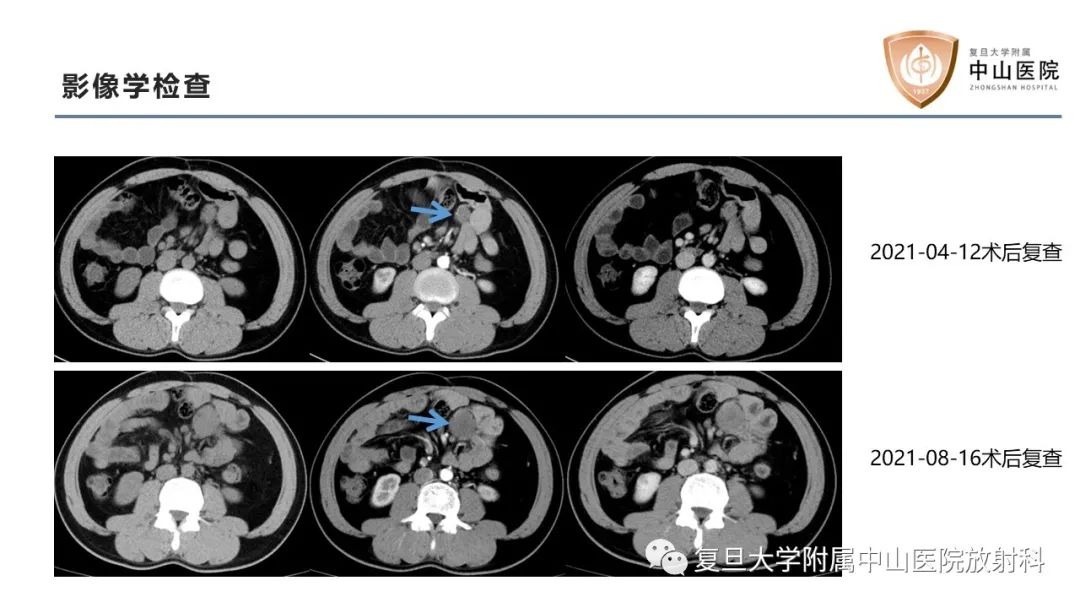 影像PPT - 【病例】肠系膜孤立性肿块3例CT影像鉴别分析-8