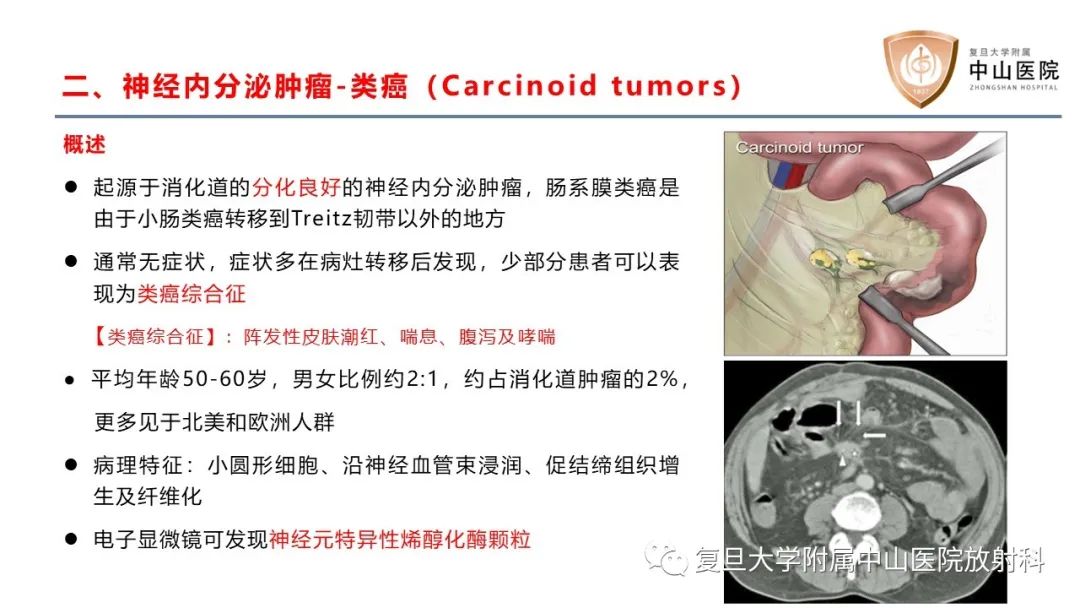 影像PPT - 【病例】肠系膜孤立性肿块3例CT影像鉴别分析-18