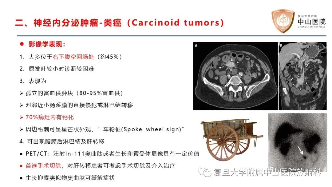 影像PPT - 【病例】肠系膜孤立性肿块3例CT影像鉴别分析-19