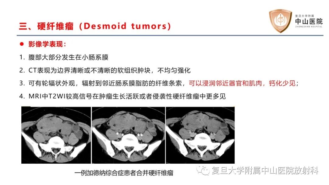 影像PPT - 【病例】肠系膜孤立性肿块3例CT影像鉴别分析-22