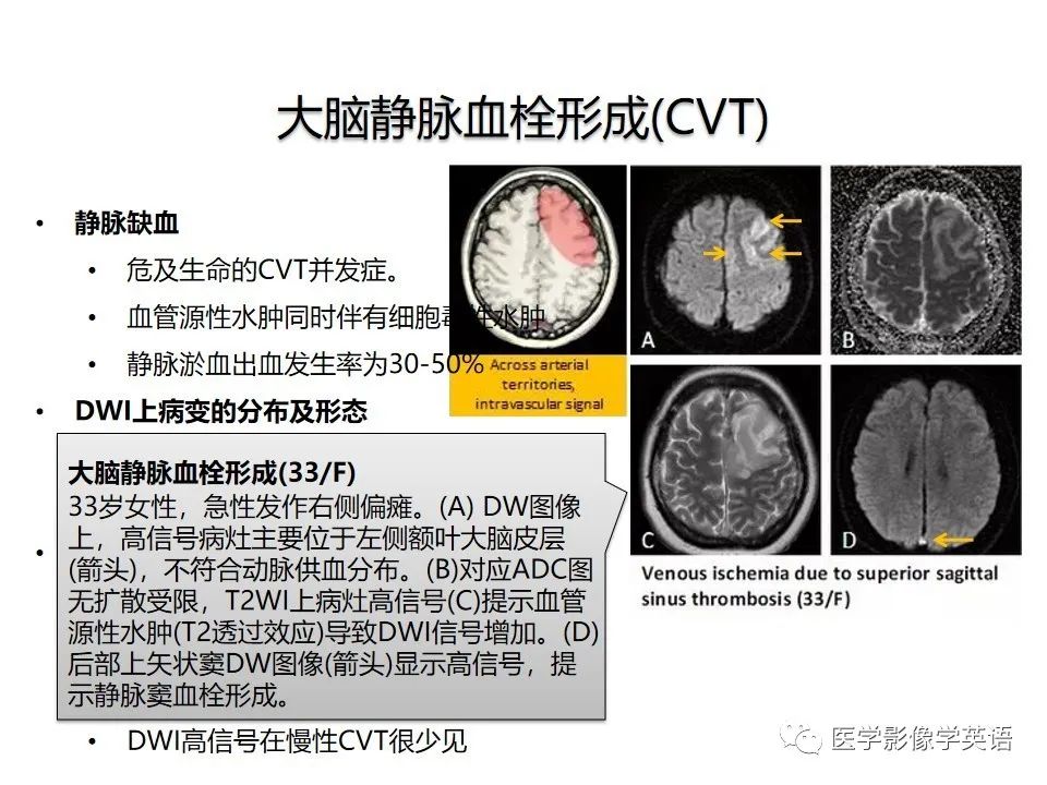 影像PPT - 【PPT】颅内DWI高信号病变：从发现病灶到准确诊断-17
